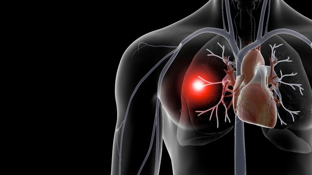 Pulmonary embolism