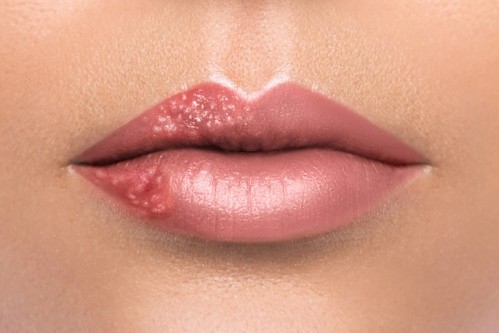 ustni-herpes-bakterii-330100-500x0.jpg