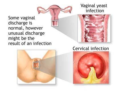 Beware of these 6 common causes of vaginal yeast infection