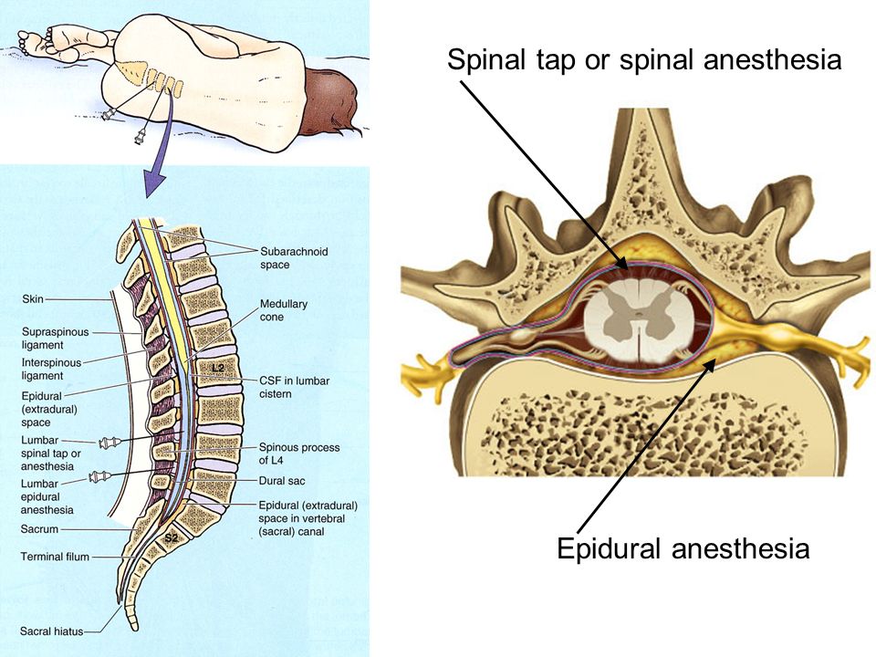 Spinal+tap+or+spinal+anesthesia.jpg