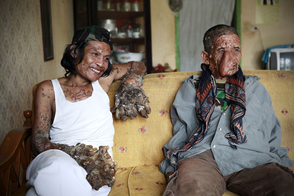 Sakim+Indonesian+Tree+Man+Continues+Treatment+68TQy8rumtDl.jpg