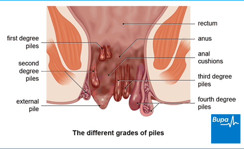 Piles-haemorrhoids.png