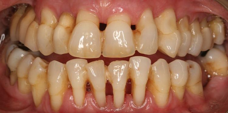 enfermedad-periodontal-21.jpg