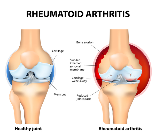 https___ghr.nlm.nih.gov_art_large_joint-with-rheumatoid-arthritis.jpeg