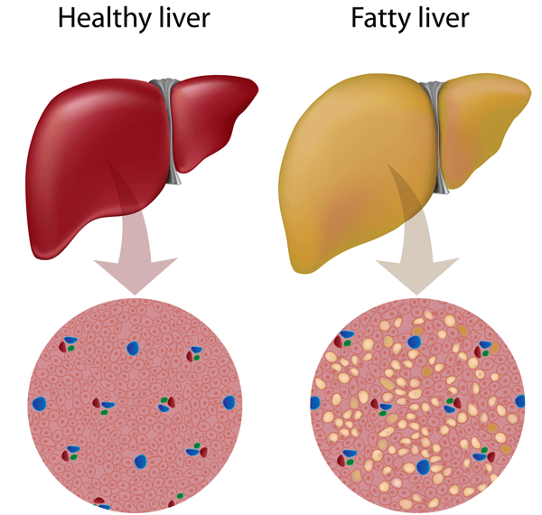 fatty-liver-illustration.png