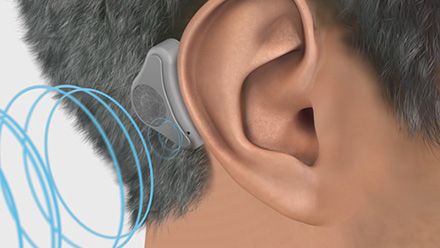 Bone Conduction Hearing Devices.jpg