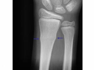 buckle-fracture-300x225.jpg