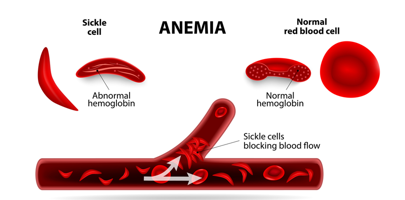 TBC-Sickle-Cell-Anaemia.png