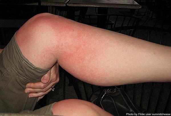 147328-600x410-heat-rash[1].jpg