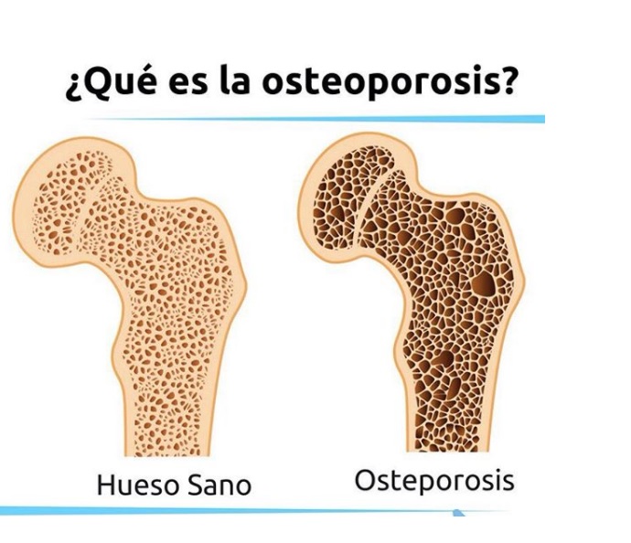 Osteoporosis.jpg