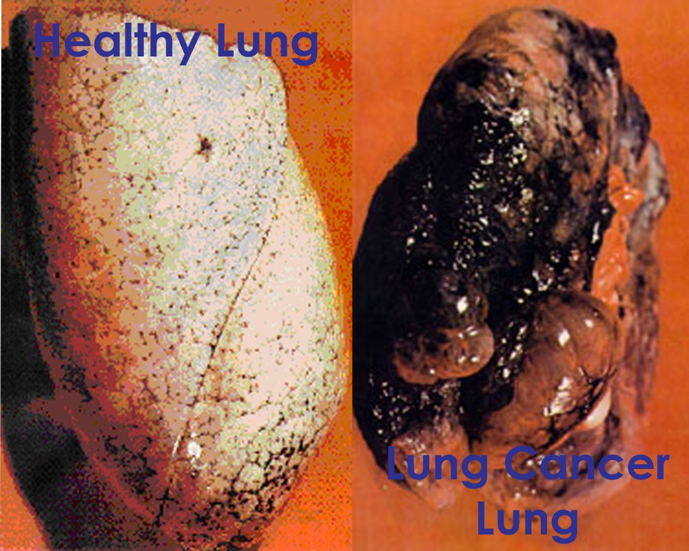Smokers-Lung-Pictures-1.jpg