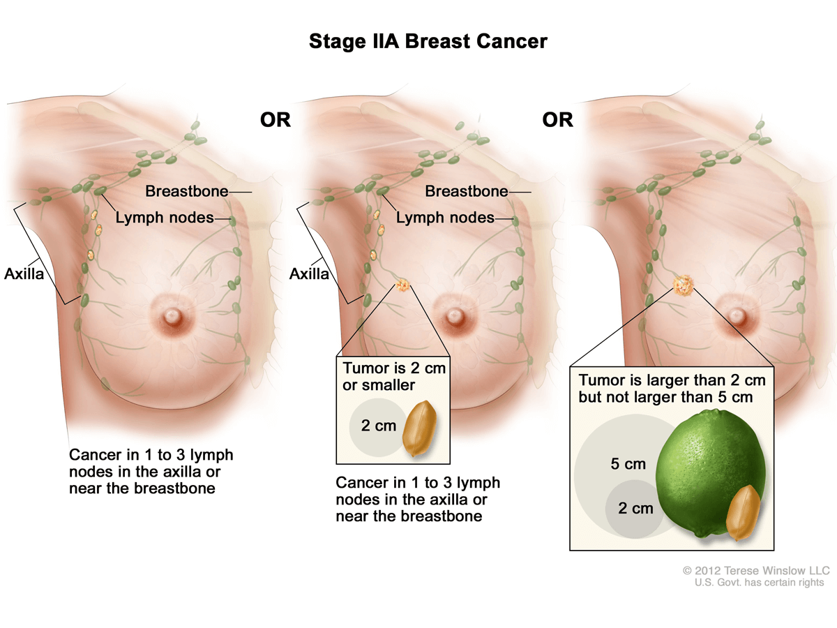 признаки опухоли в груди у женщин фото 11