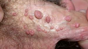 human papilloma virus infection.jpg