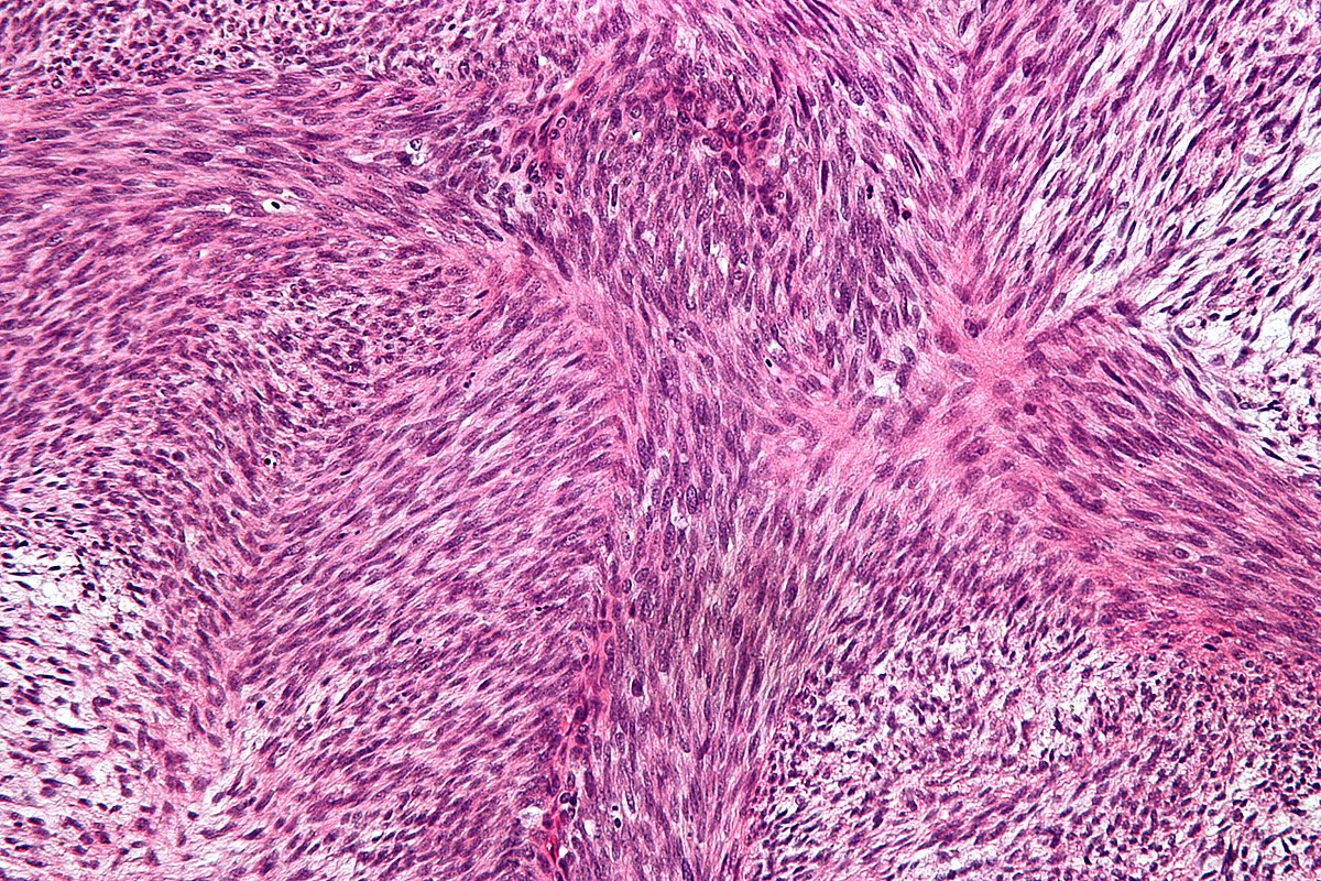 1200px-Malignant_peripheral_nerve_sheath_tumour_-_high_mag.jpg