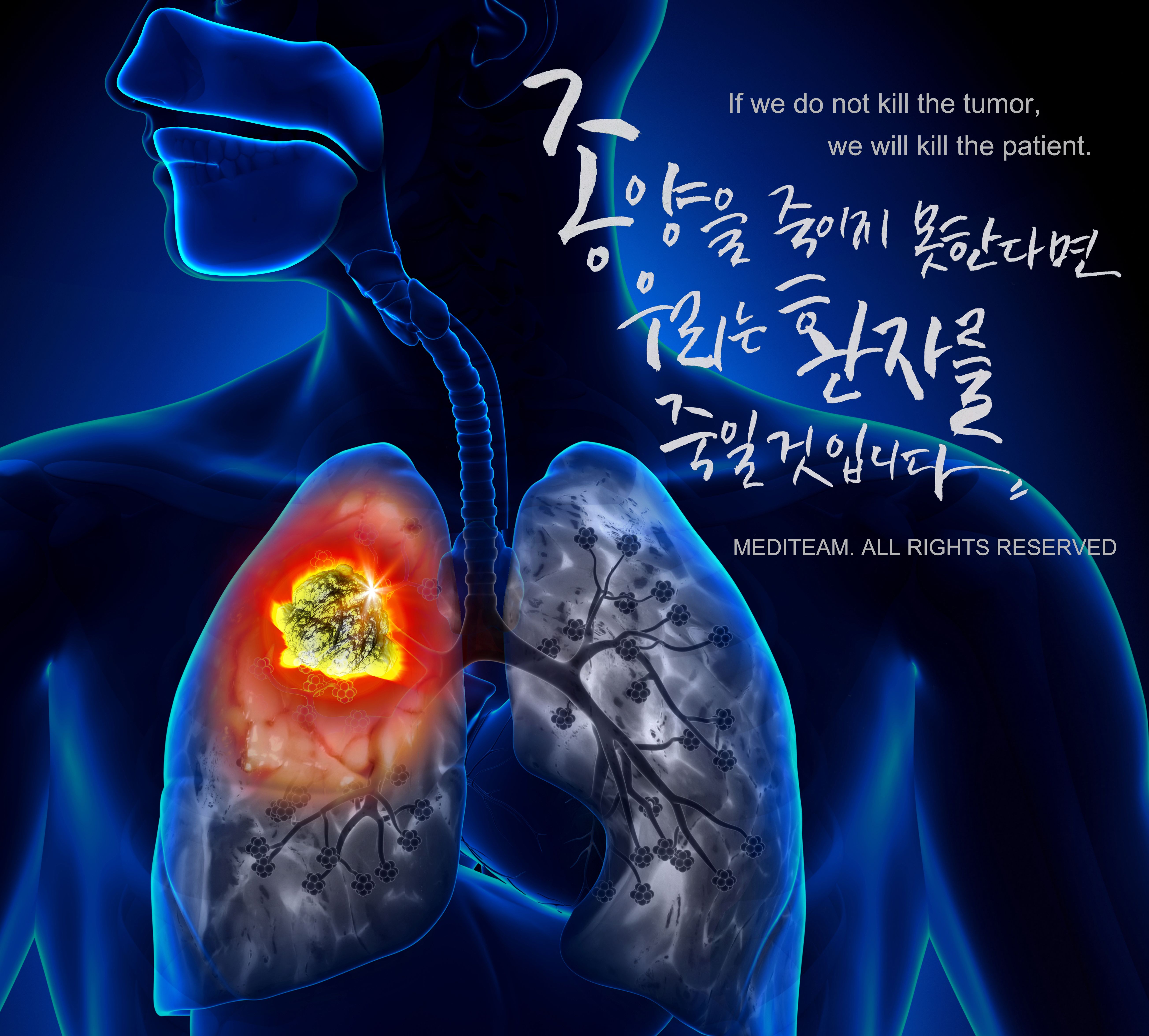 Can You Get Testicular Cancer From A Laptop