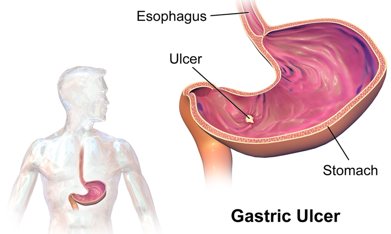 Gastric_Ulcer.png
