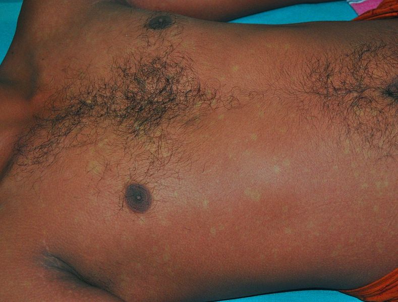 Dengue_recovery_rash_(White_islands_in_red_sea).jpg