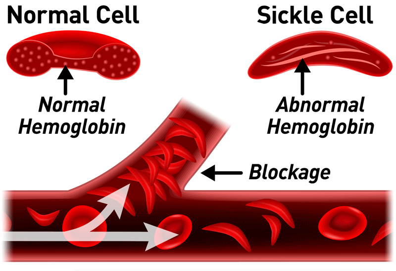 scleral icterus and sickle cell anemia