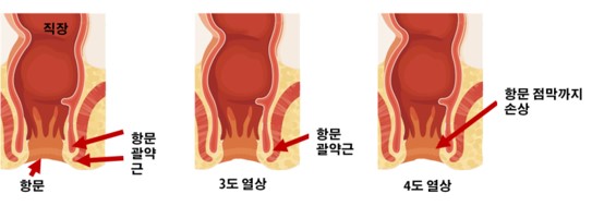 회음부절개-중증회음부열상.jpg