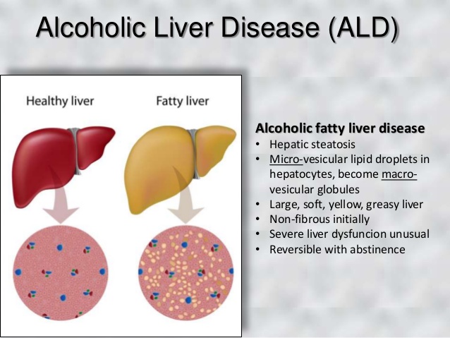 Non alcoholic liver disease