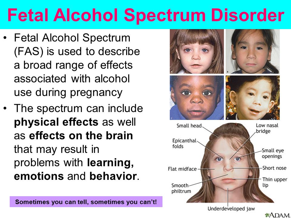 Реферат: Fetal Alcohol Syndrome And Fetal Alcohol Effects