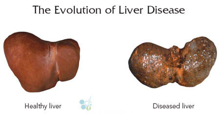 Compare-End-Stage-Liver-Disease-Cure-Treatment.jpg