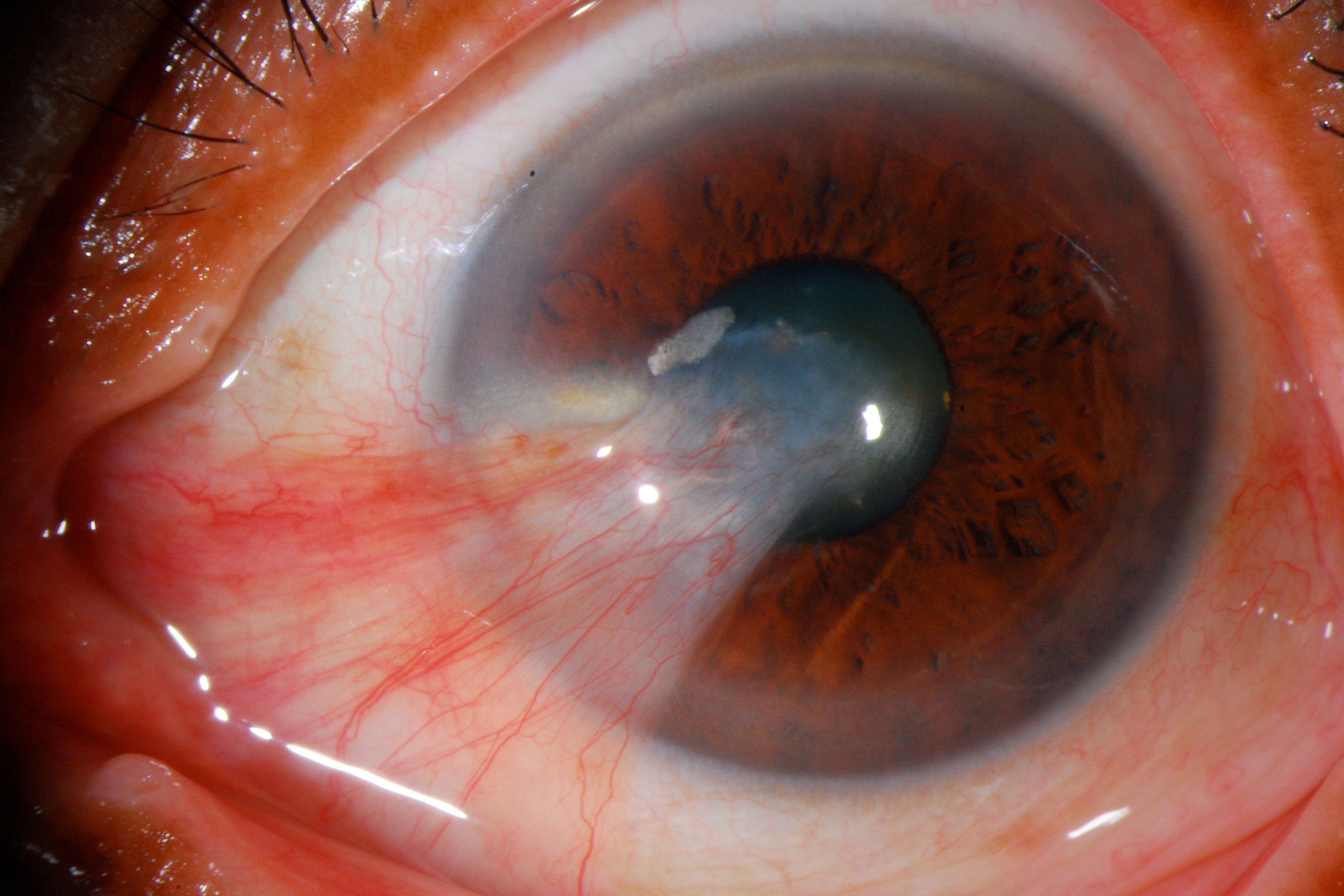 Pterygium_Slitlamp.jpg