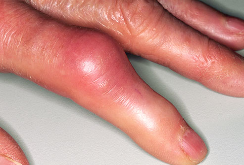 Gout-in-Finger.jpg