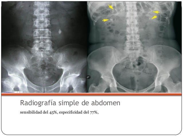 nefrolitiasis-14-638.jpg