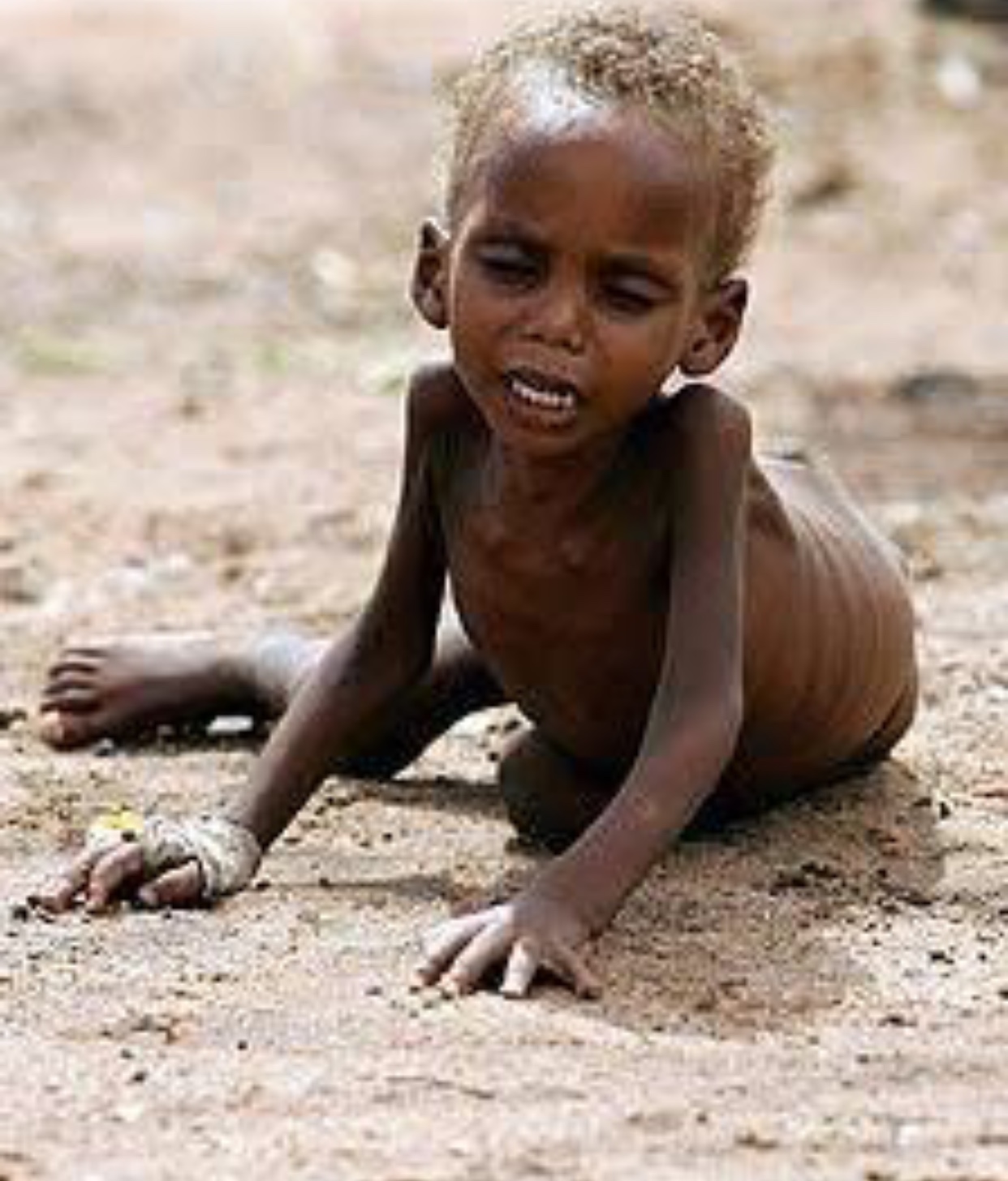 Голод кожи. Африка голодный ребёнок худой. Бедные африканские дети.