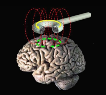 Transcranial_magnetic_stimulation.jpg