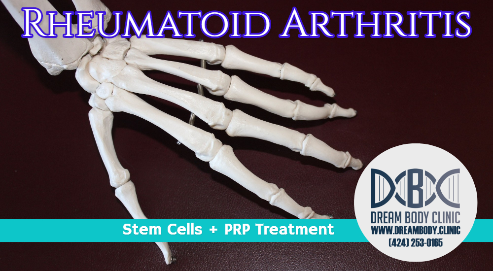 stem cell rheumatoid arthritis treatment.jpg