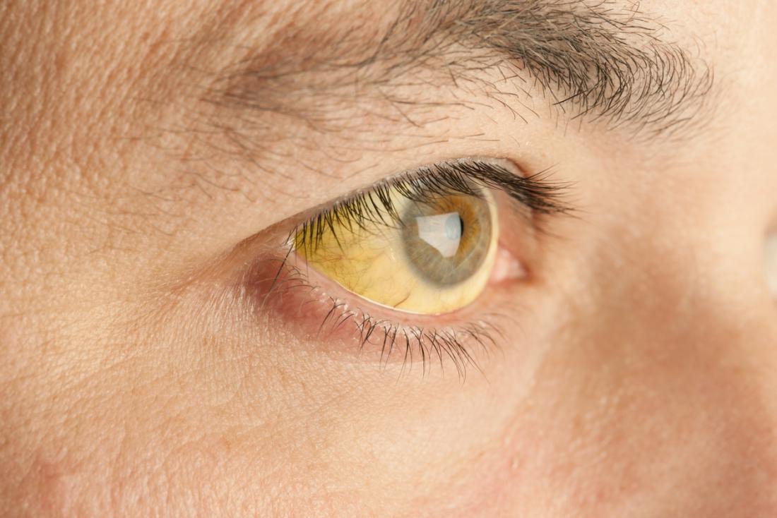 jaundice-eye.jpg