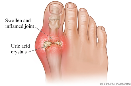 gout.jpg