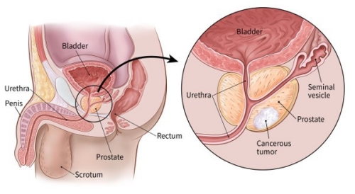 prostate cancer 2.jpg