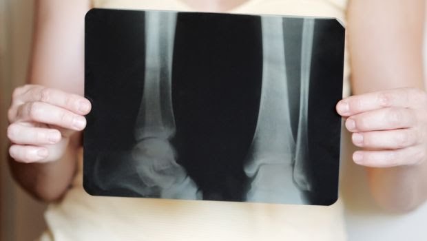 bone-loss-620_620x350_61476703099.jpg