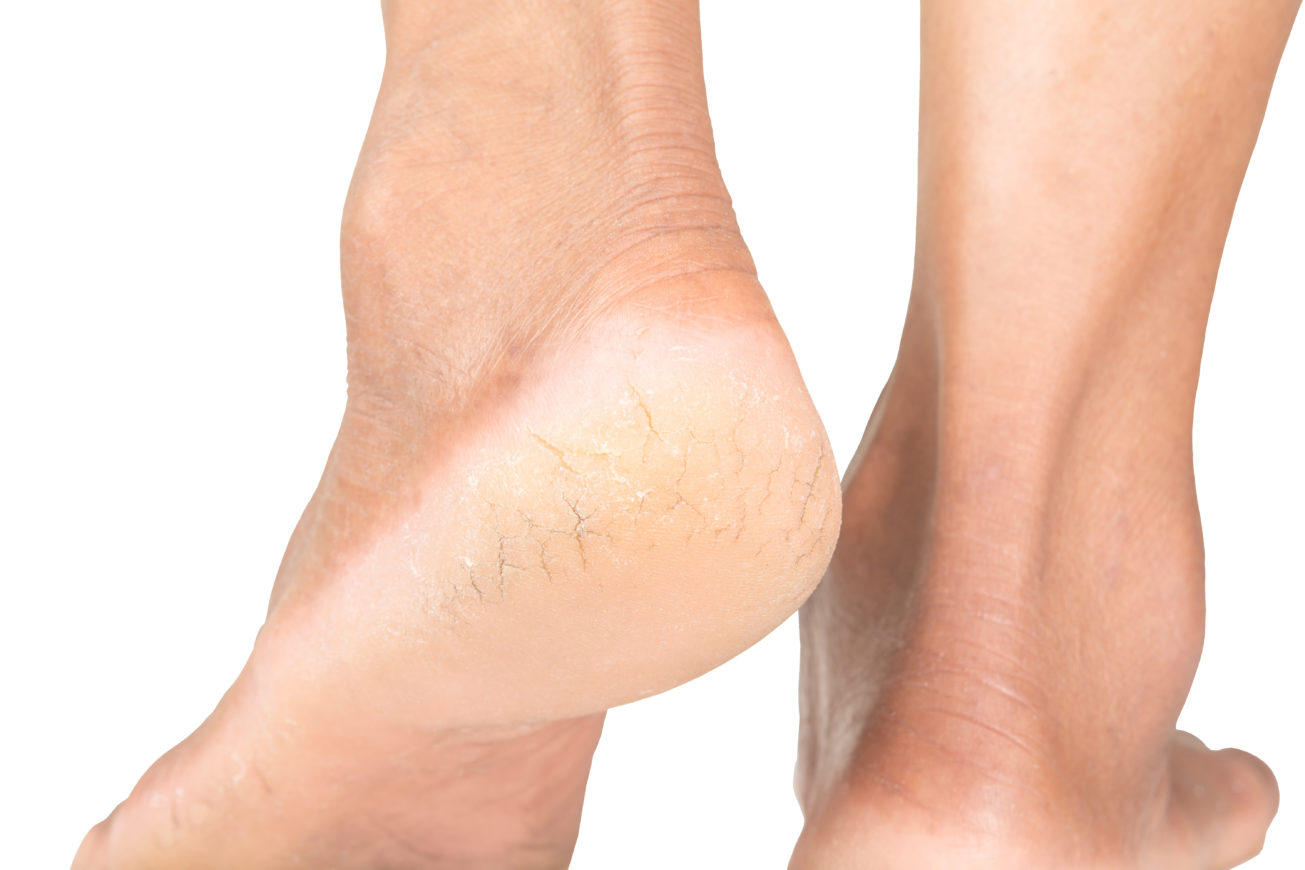 Say goodbye to cracked heels with these easy home remedies
