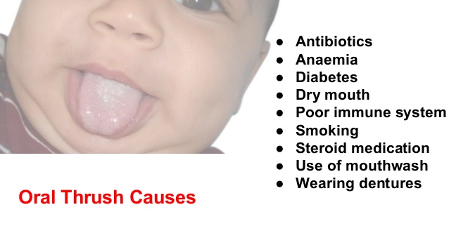 oral thrush from antibiotics