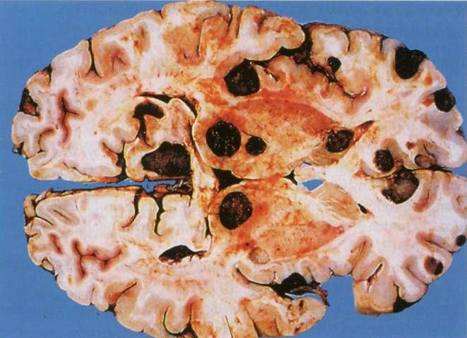 Przerzut do mozgu.jpg