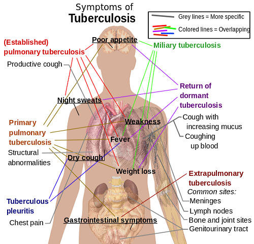 541px-Tuberculosis_symptoms.svg_.png