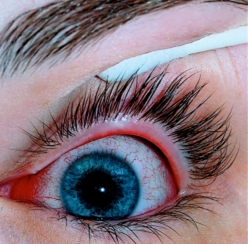 An eye with viral conjunctivitis.PNG