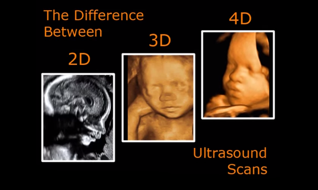 3d vs 4d ultrasound
