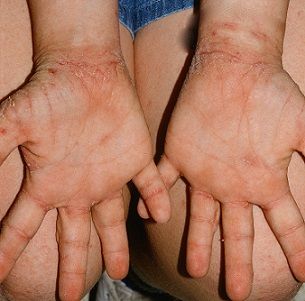 Hand dermatitis.jpg