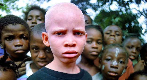 albinismo.jpg