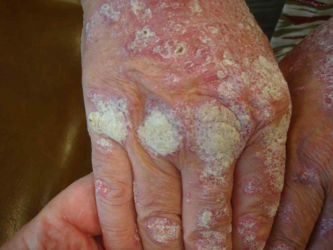 scabies-hands-infant-youtube-a-crusted-scabies-hands-rare-variant-of-medical-observer-a-crusted-scabies-hands-rare-variant-of-medical-observer.jpg