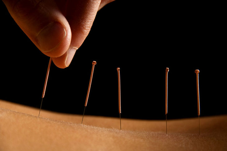 srv-acupuncture.jpg