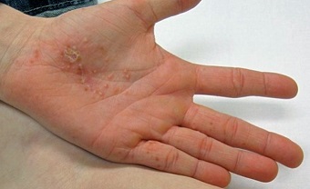 Pompholyx eczema.jpg