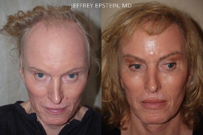 patient-41309-transgender-before-after-5.jpg