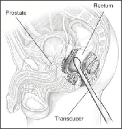 Transrectalultrasound.jpg