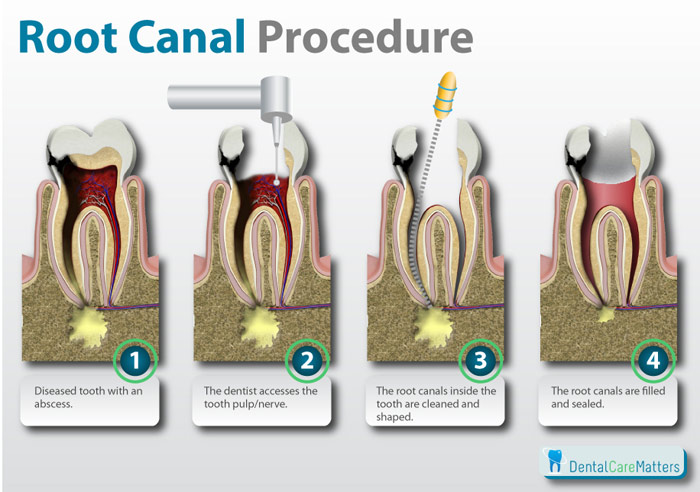 Root-canal-procedure.jpg